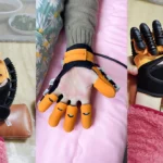 Soft robotic hand rehabilitation glove worn on a patient’s hand, designed for stroke recovery and post-surgery therapy at home.