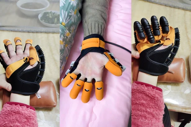 Soft robotic hand rehabilitation glove worn on a patient’s hand, designed for stroke recovery and post-surgery therapy at home.